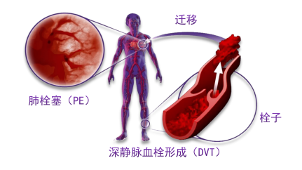 骨科術(shù)后重點關(guān)注的問題—VTE，該如何防治？