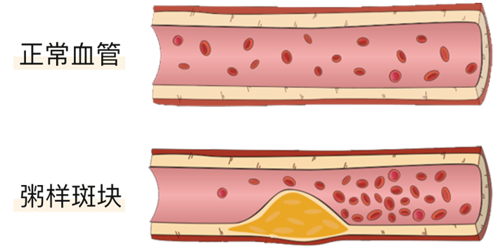 血栓是心梗、腦梗的元兇，很容易找上這些人