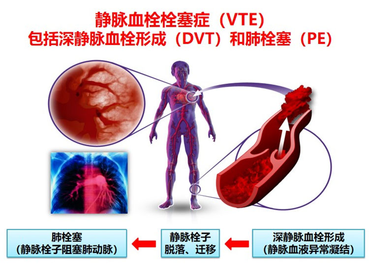 世界血栓日 | 拴不住，動起來