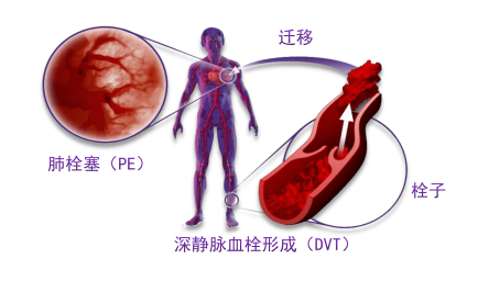 骨科術(shù)后重點(diǎn)關(guān)注的問(wèn)題—VTE，該如何防治？