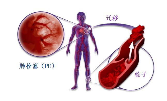 動(dòng)脈血栓和靜脈血栓有什么區(qū)別嗎？