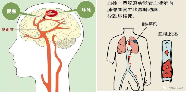 腦梗與深靜脈血栓：不可忽視的血管危機(jī)